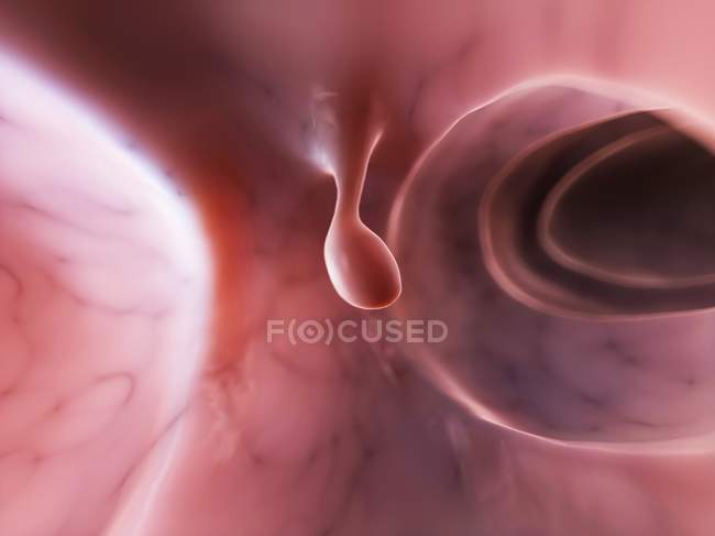 Procedura di rimozione del polipo del colon — Foto stock