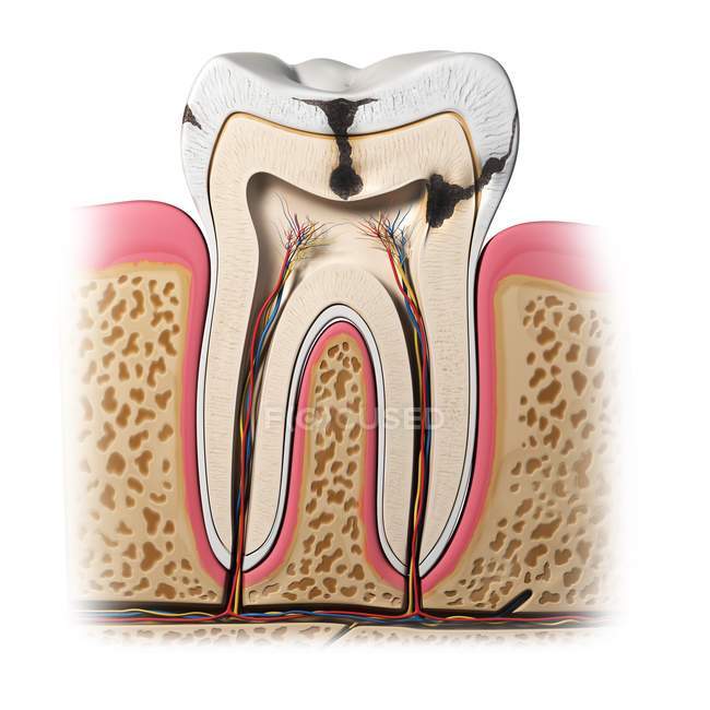Patologia della carie dentale — Foto stock