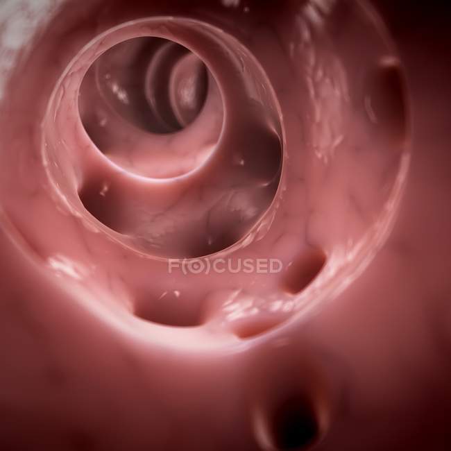 Diverticoli del colon patologia — Foto stock