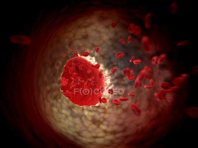 Патофизиология артериосклероза — стоковое фото