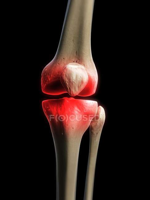Visualización de la rodilla dolorosa - foto de stock