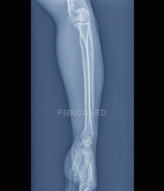 Codo y articulaciones normales de la muñeca, rayos X - foto de stock