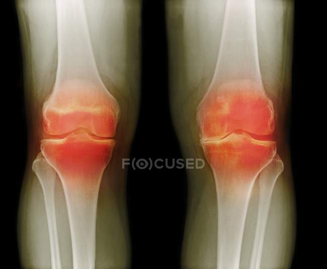 Radiografia colorida de joelhos artríticos — Fotografia de Stock