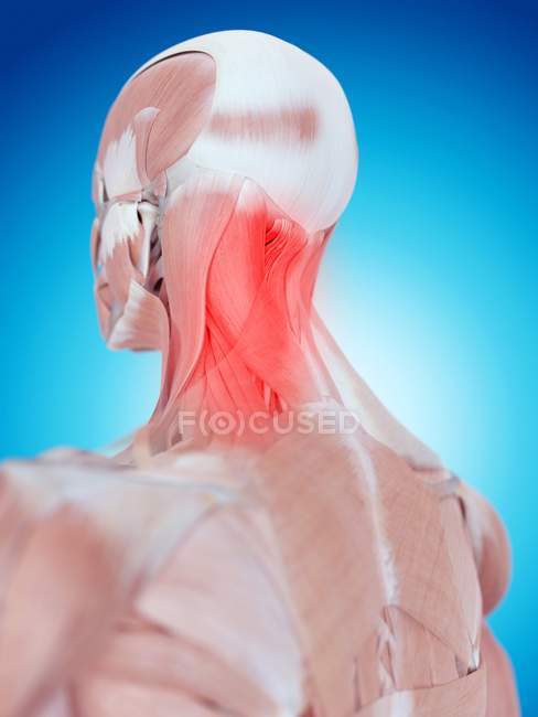 Боли в шее, влияющие на мышцы — стоковое фото