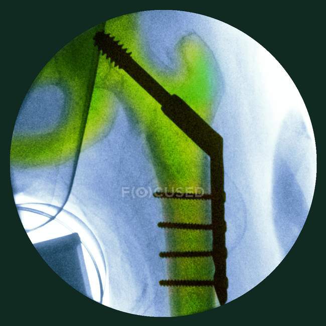 Pinned перелом стегна — стокове фото