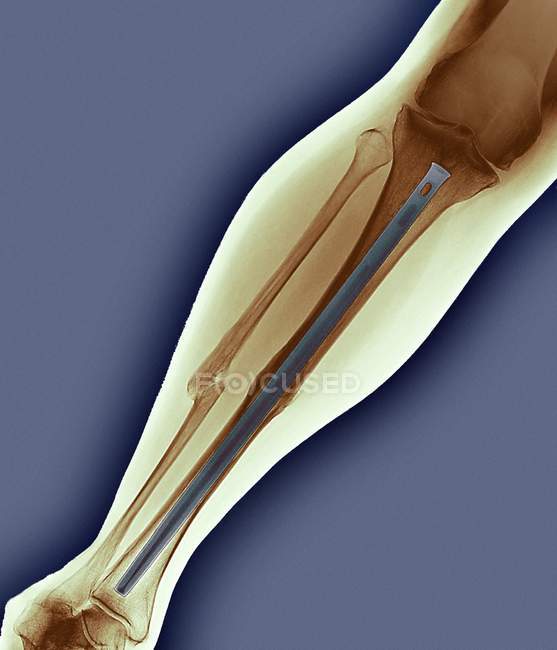 Pinned broken leg, coloured X-ray. — Stock Photo