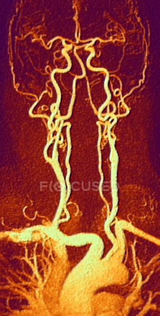 Arteria toracica, cervicale e cranica — Foto stock