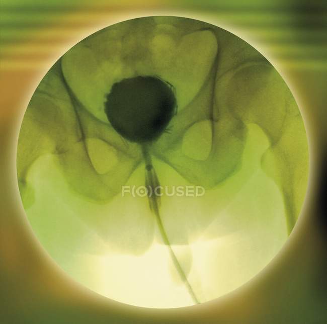 Normal bladder, coloured cystogram (bladder X-ray). — Stock Photo