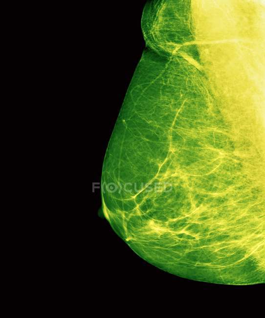 Скрининг рака молочной железы — стоковое фото