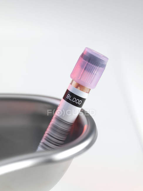 Primer plano de la muestra de sangre en el plato de riñón
. - foto de stock