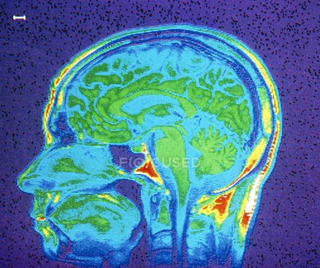 МРТ нормального мозга — стоковое фото