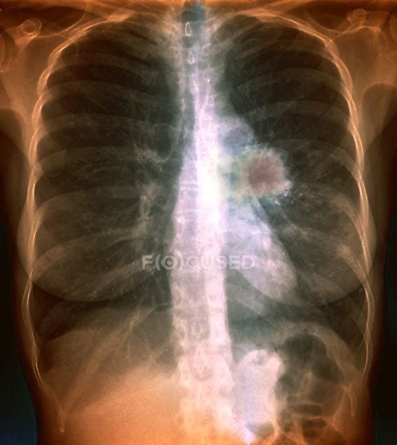 Farbiges Röntgenbild zeigt Krebs in der linken Lunge eines 55-jährigen Patienten. — Stockfoto