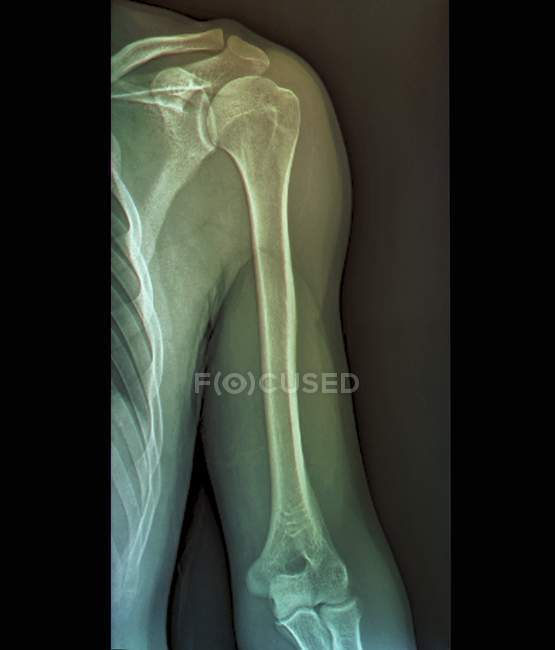 Anatomia delle articolazioni della spalla e del gomito — Foto stock