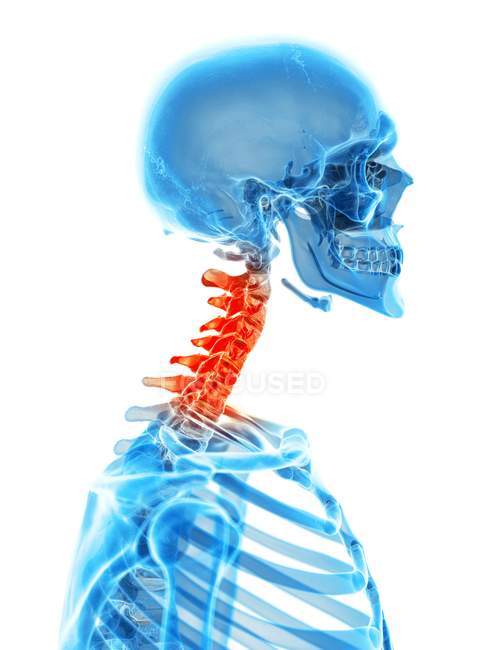 Dolore alla colonna vertebrale cervicale umana — Foto stock