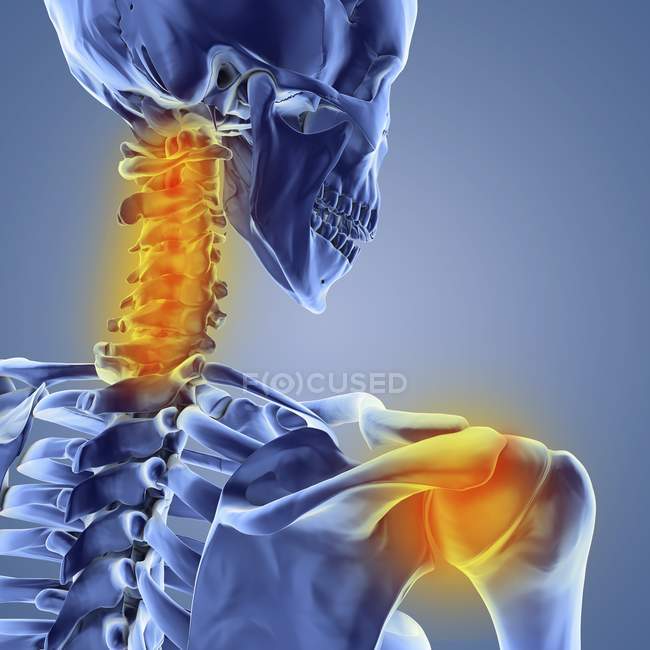 Neck and shoulder pain — Stock Photo