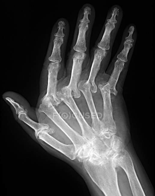 Arthritic hand anatomy — Stock Photo