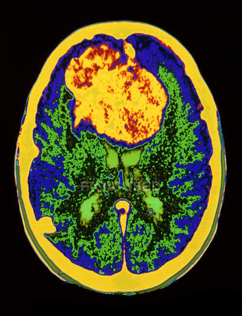 View of meningioma tumor — Stock Photo