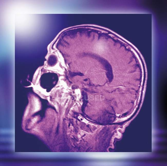 Cabeza y cerebro normales, resonancia magnética - foto de stock