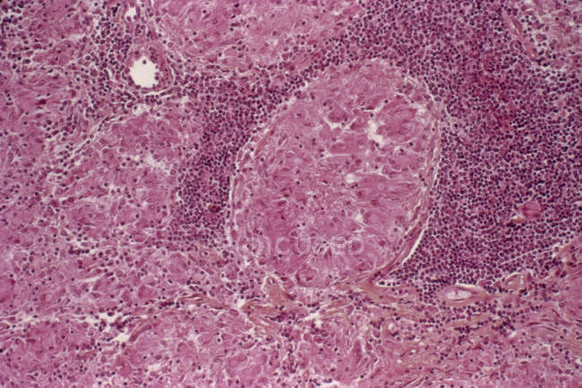 Lymph node in tuberculosis — Stock Photo