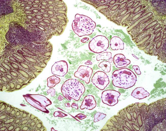 Estomago infectado con gusanos nematodos parásitos - foto de stock