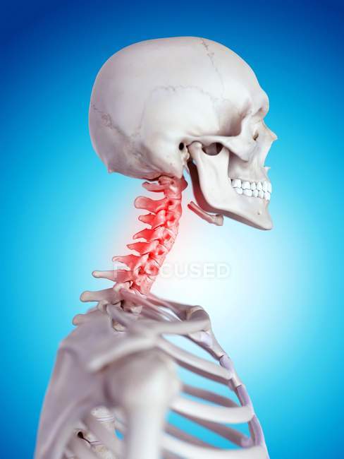 Dolor de cuello humano - foto de stock