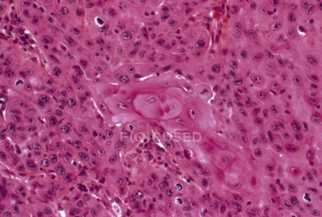 Рак шкіри епідермоїдної карциноми — стокове фото