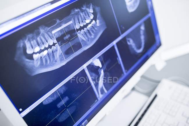 Primo piano del display a raggi X dei denti sullo schermo del monitor nella clinica dentale . — Foto stock