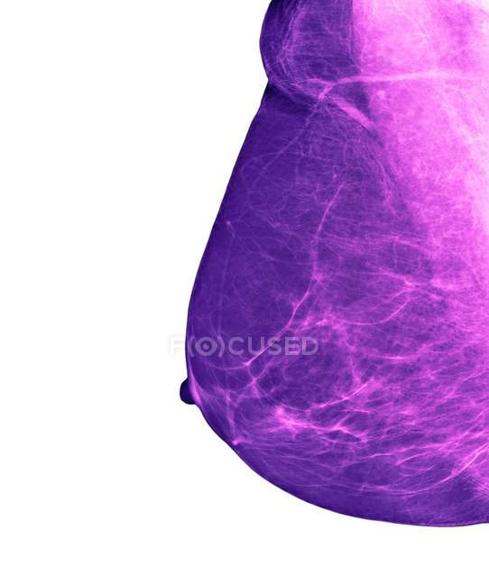 Brustkrebs-Früherkennung — Stockfoto