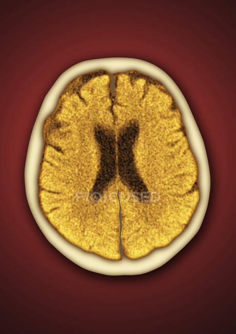 Здоровый человеческий мозг — стоковое фото