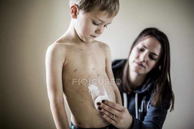 Mother applying cream to son with chickenpox. — Stock Photo