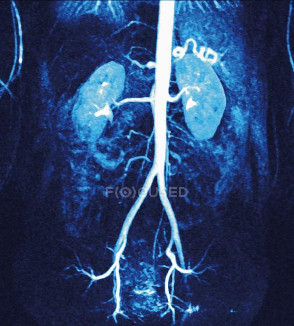 Angiographie par résonance magnétique colorée (ARM) des artères (blanches) alimentant les reins (bleu, supérieur gauche et droit) ). — Photo de stock
