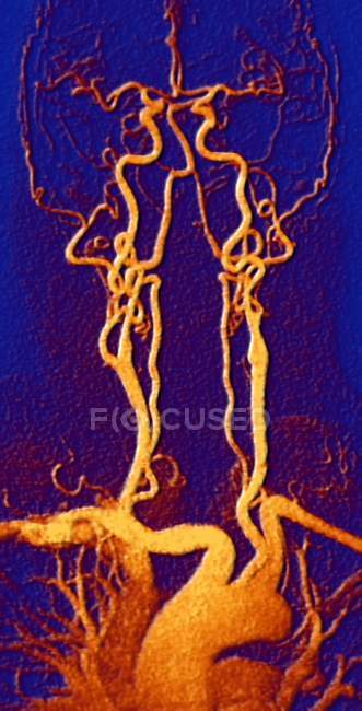 Chest, neck and head arteries — Stock Photo