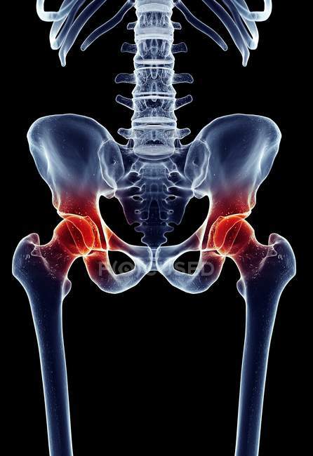 Douleurs articulaires de la hanche — Photo de stock