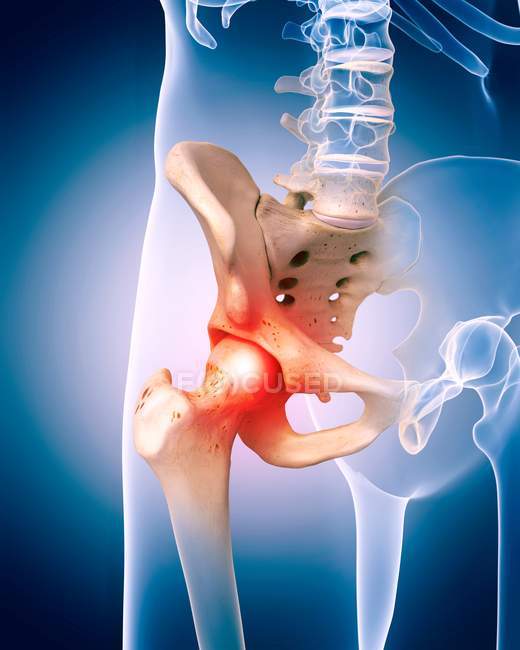 Pain in hip joint — Stock Photo
