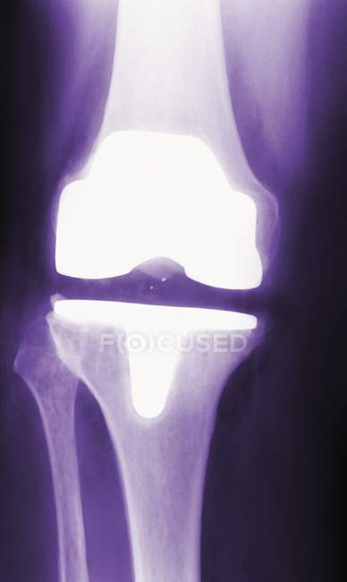 Coloured frontal X-ray of an artificial knee joint (white). — Stock Photo