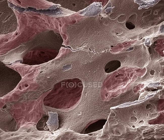 Аномалія остеопорозу кістка — стокове фото