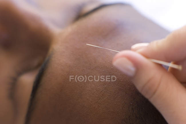 Acupuncturist inserting needle into male client forehead, close-up. — Stock Photo