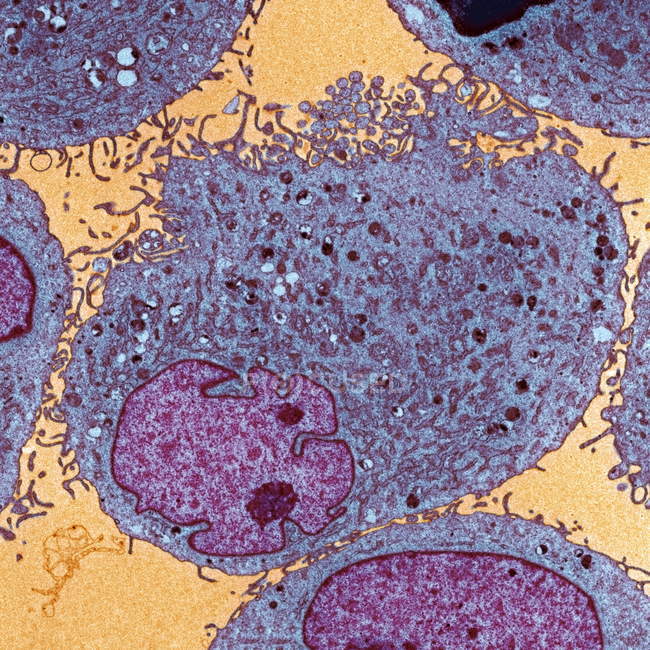 Células leucémicas en un paciente con síndrome de Bloom, micrografía electrónica de transmisión coloreada (TEM) ). - foto de stock