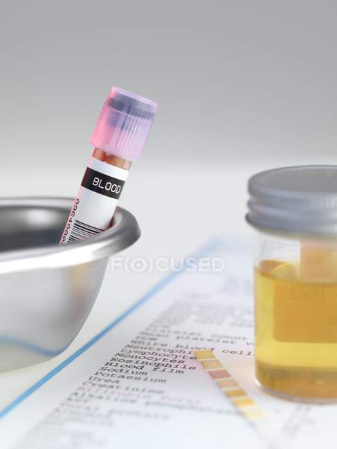 Blutprobe in Nierenschale mit Urinprobe auf Tisch. — Stockfoto