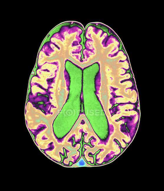 Повреждение мозга органофосфатом — стоковое фото