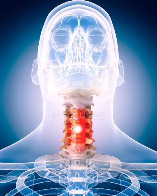 Neck pain localized in cervical vertebrae — Stock Photo