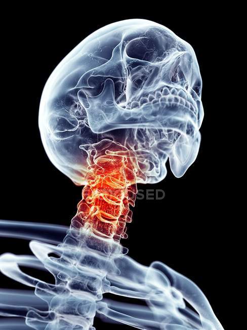 Neck pain localized in cervical vertebrae — Stock Photo