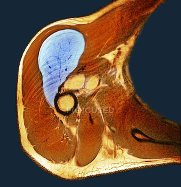 Рентген великої ліпоми плечей — стокове фото