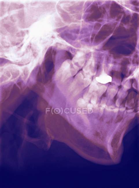 Profil coloré Rayons X d'une mandibule humaine (mâchoire inférieure ). — Photo de stock