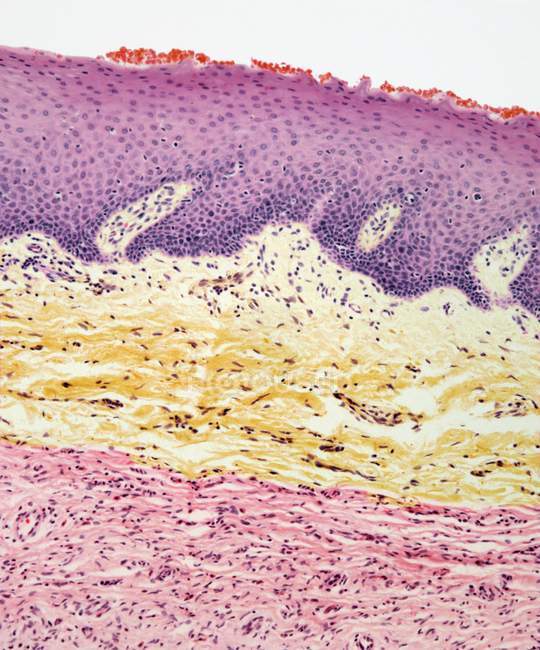 Micrografía ligera de una sección a través de la piel con un tumor de neurofibroma (rosa, en la parte inferior)
). - foto de stock