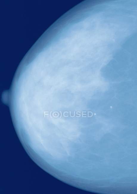 Кольоровий профіль (вид збоку) Рентгенівський знімок здорової грудей . — стокове фото