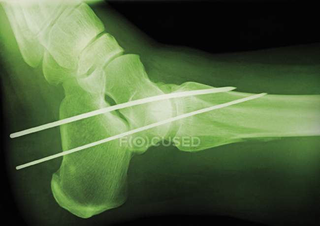Temporary ankle immobilisation, coloured profile X-ray. — Stock Photo
