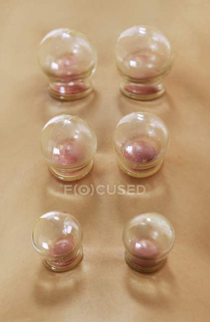 Close-up of heated cups on client back for cupping therapy. — Stock Photo