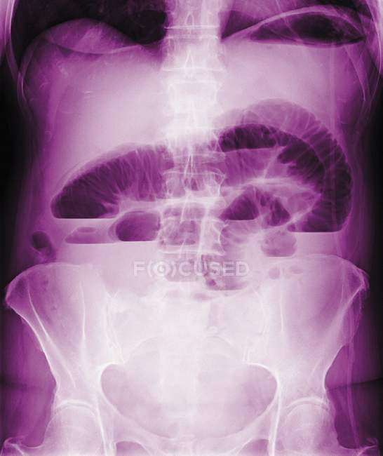 Coloured frontal X-ray of a blocked intestine (upper centre). — Stock Photo