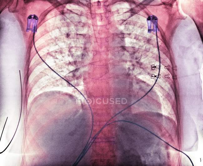 Radiografía de tórax de color que muestra aspiración (áreas oscuras) en los pulmones de una paciente de 76 años con una hemorragia cerebral extensa . - foto de stock